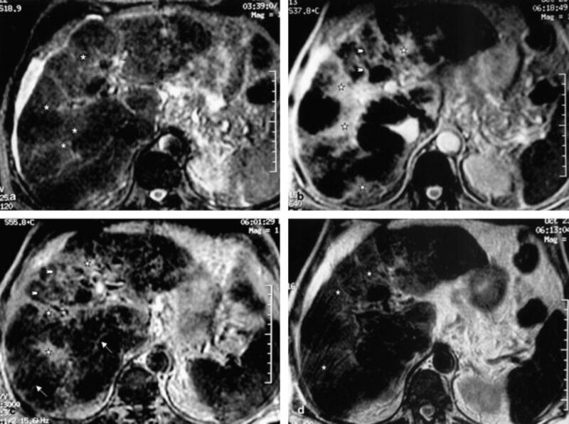 Risonanza magnetica in uomo di 59 anni con cirrosi alcolica