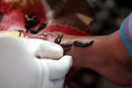 La terapia delle sanguisughe nel Kashmir indiano 12