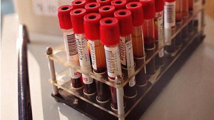 Se basta l'esame del sangue a stanare il cancro ai polmoni