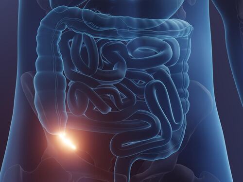 Cancro dell'appendice: cosa rivelano i nuovi studi