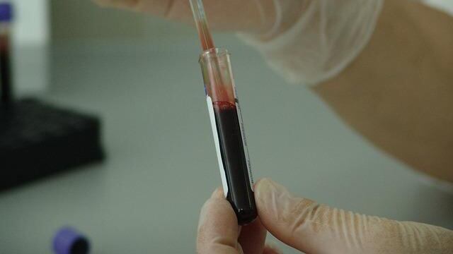 Leucemia mielomonocitica giovanile, scoperto target terapeutico