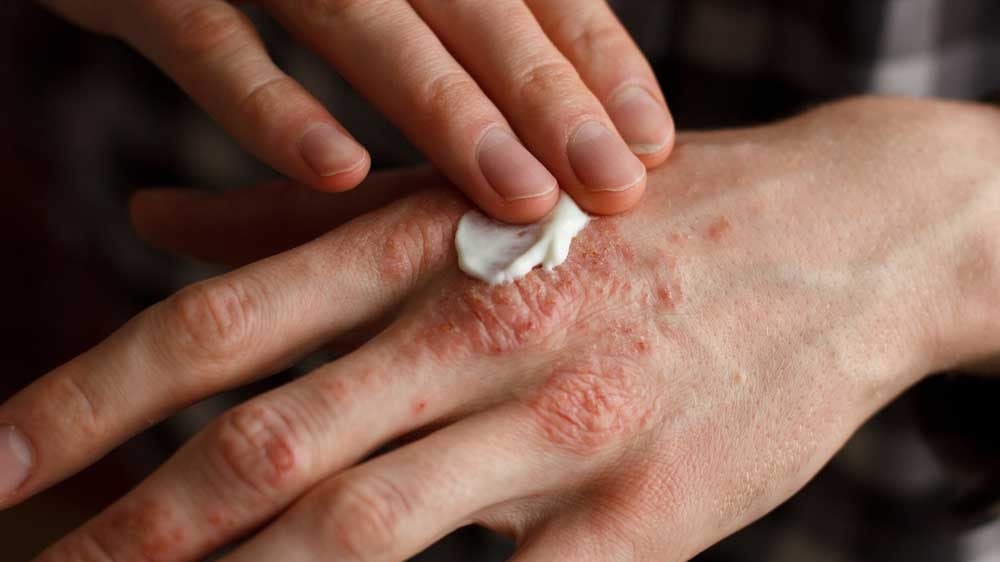Focus su psoriasi e dermatite seborroica