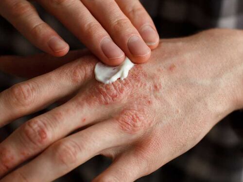Focus su psoriasi e dermatite seborroica