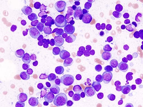 Mieloma multiplo, al via la terapia sottocutanea