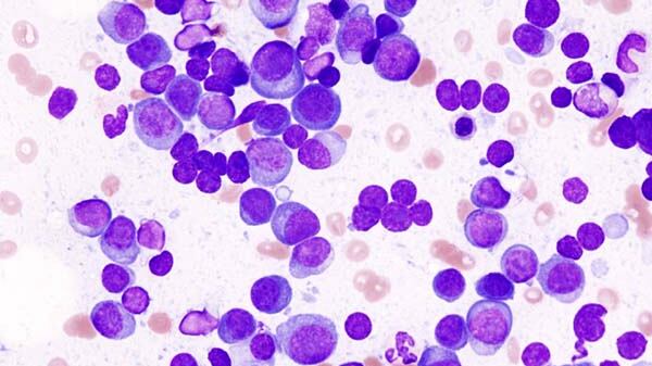 Mieloma multiplo, al via la terapia sottocutanea