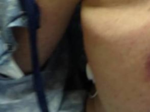 Batteri mangiacarne, uomo muore dopo 48 ore