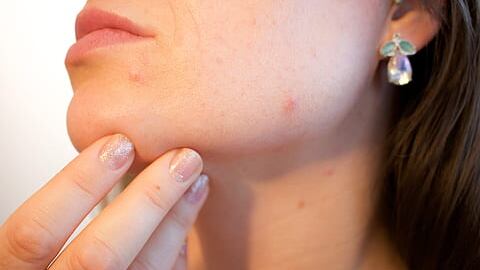 Acne da mascherina o "maskne": perché si manifesta?