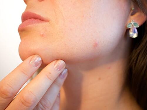 Acne da mascherina o "maskne": perché si manifesta?