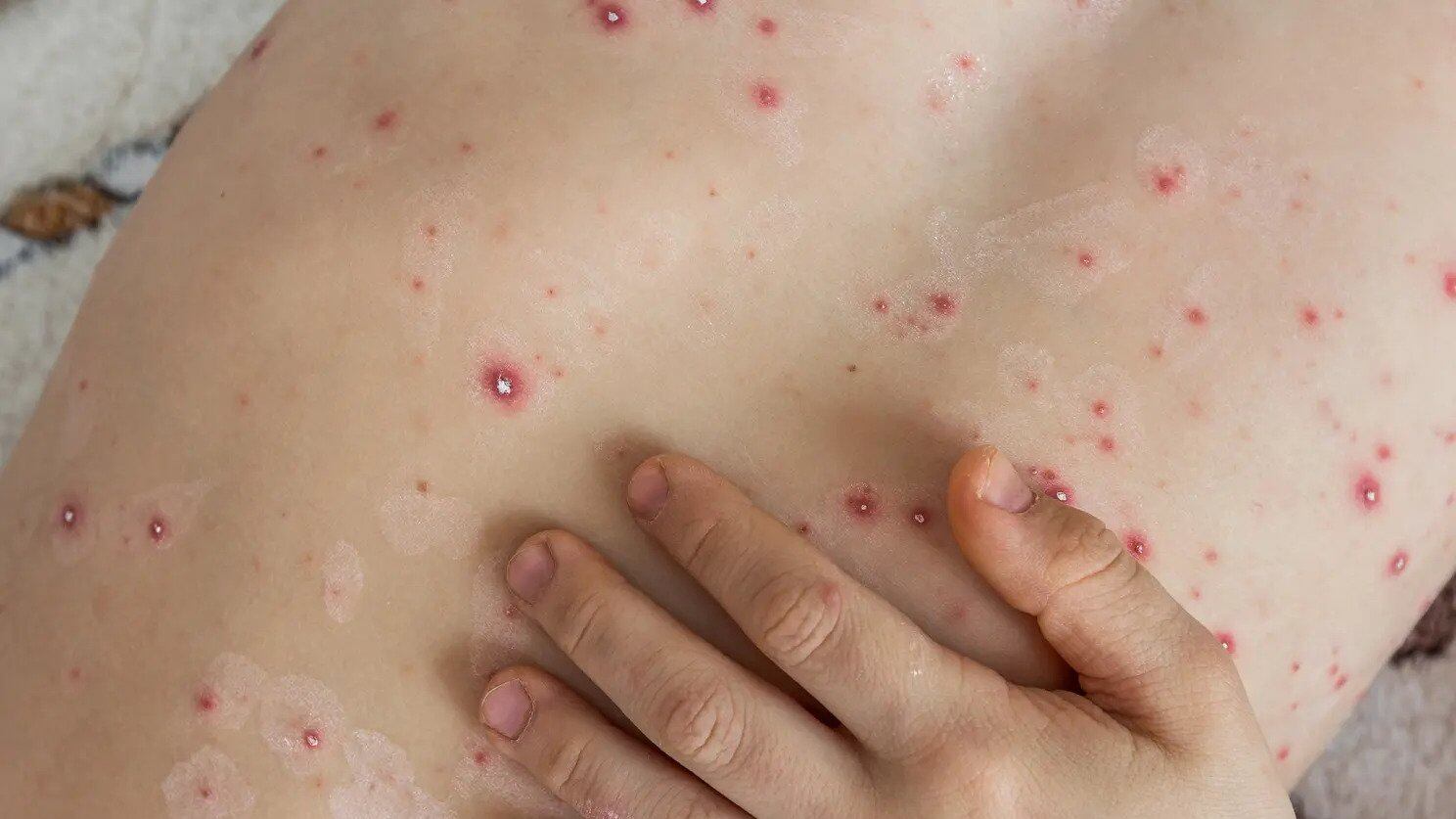 Cos'è "l'influenza del pomodoro" che allarma l'India