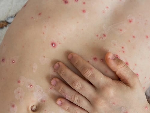 Cos'è "l'influenza del pomodoro" che allarma l'India