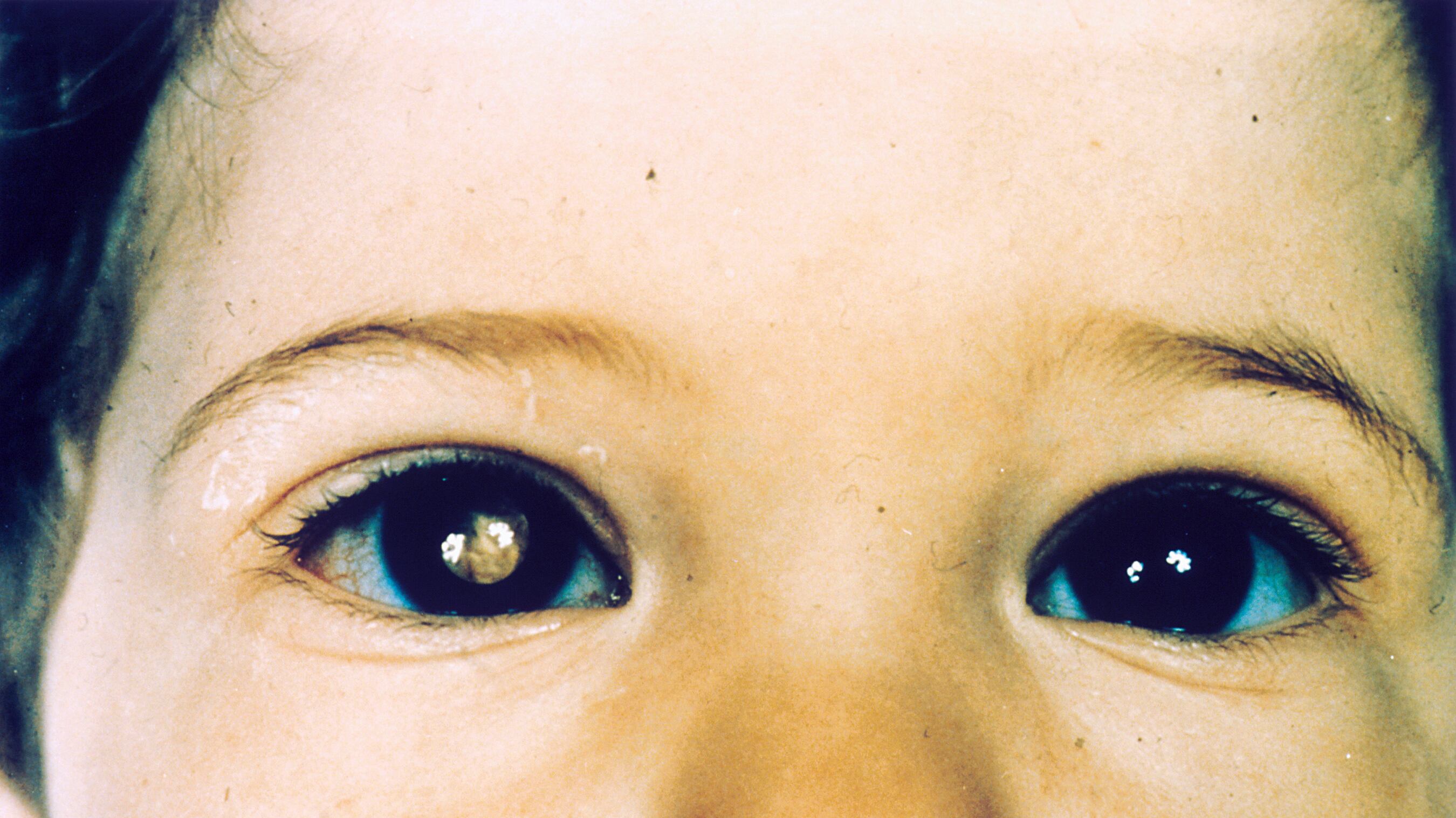 Retinoblastoma, cos'è e quali sono i sintomi