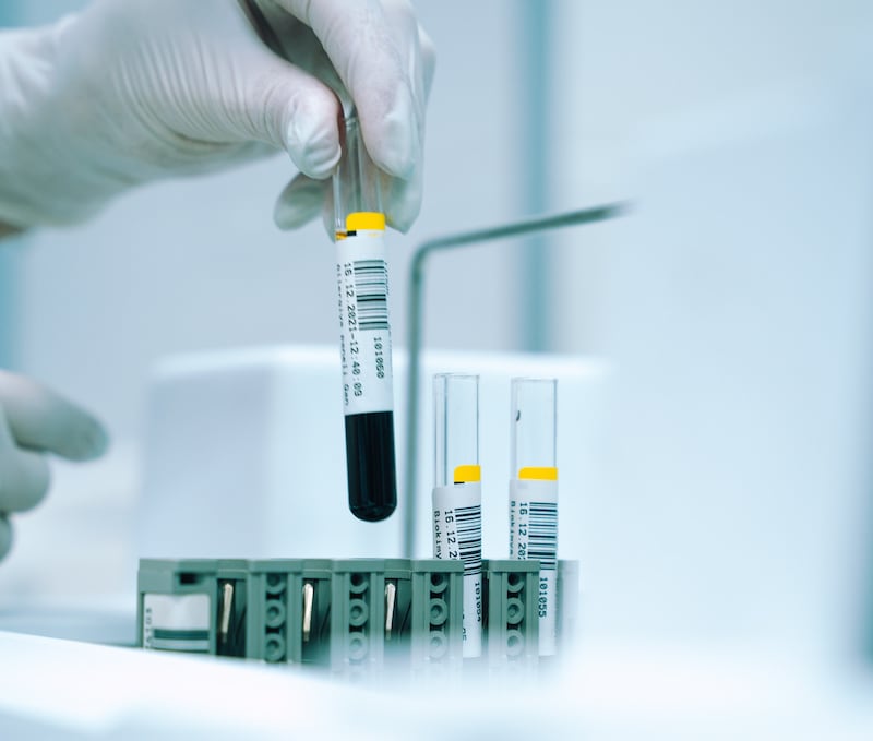Scovare un tumore con le analisi del sangue: come funziona il test