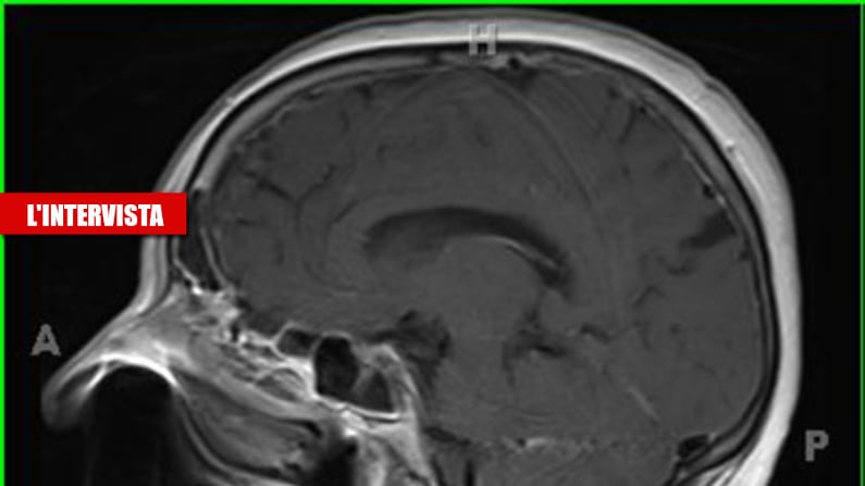 Covid-19 e i danni il cervello: così viene colpito indirettamente