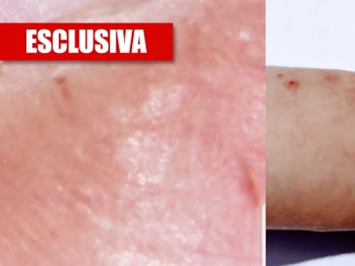 Ecco la verità sul coronavirus: "Pelle esposta nel 45% dei casi"
