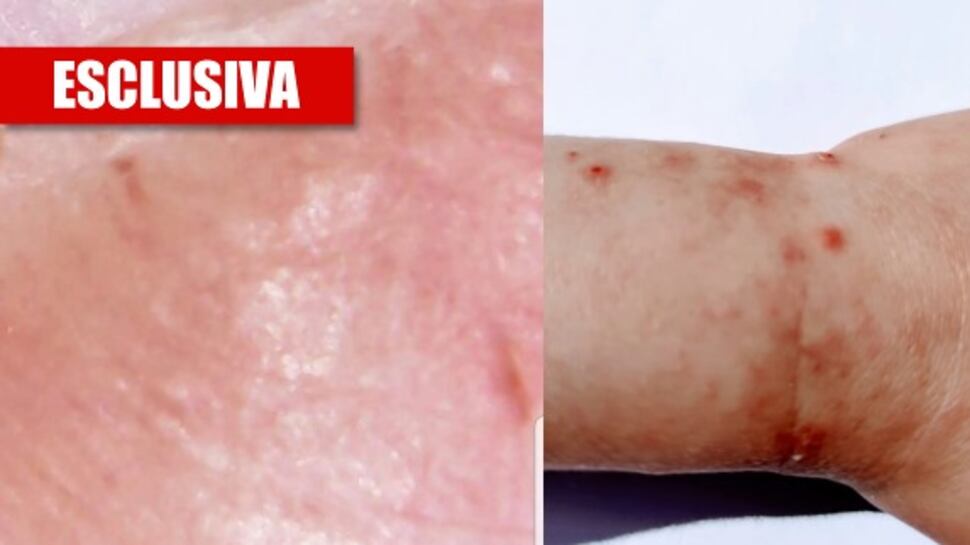 Ecco la verità sul coronavirus: "Pelle esposta nel 45% dei casi"