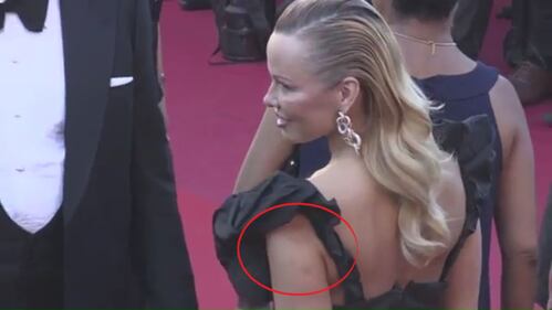 Cannes, Pamela Anderson sul red carpet con il braccio pieno i lividi 3