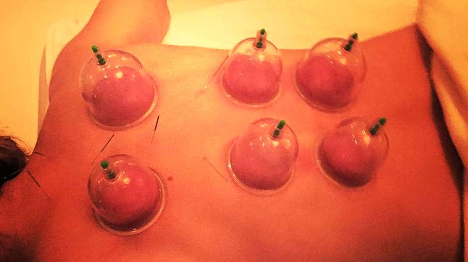 Vacuum Therapy: il massaggio con le coppette per il corpo