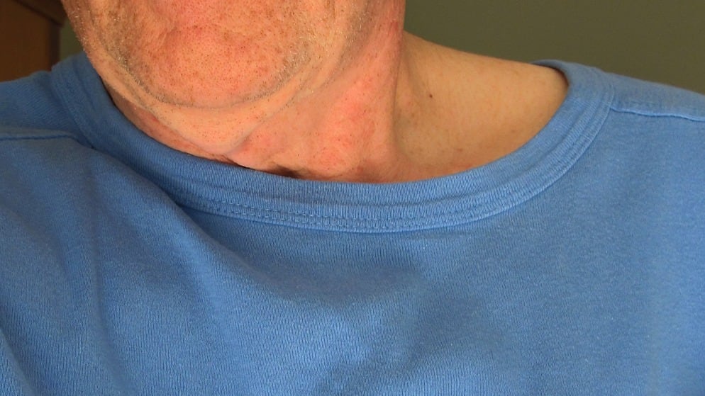 Salvarsi da un infarto tossendo? La pericolosa tecnica fake diventata virale