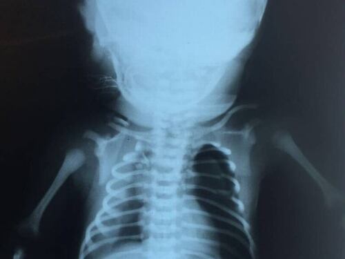 Brasile, colpito da un proiettile nella pancia della mamma: il bimbo resterà paraplegico
