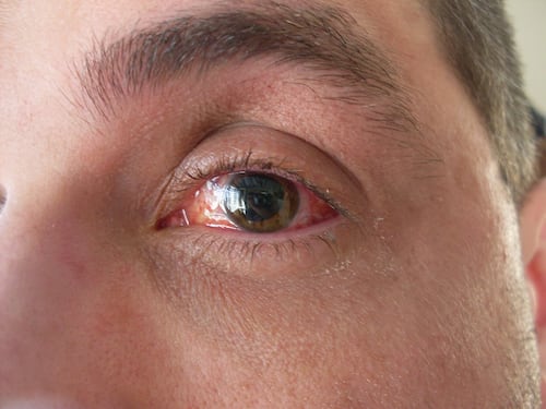Distacco della retina, come si manifesta?