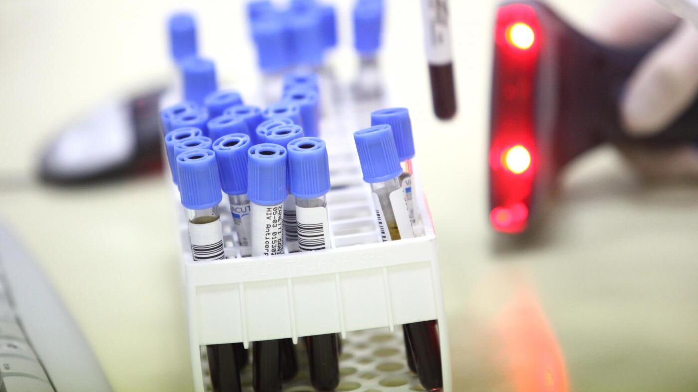 Sapremo se abbiamo il tumore al polmone con un test del sangue
