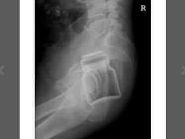 Pazze radiografie: gli oggetti che possono finire nel corpo umano 5