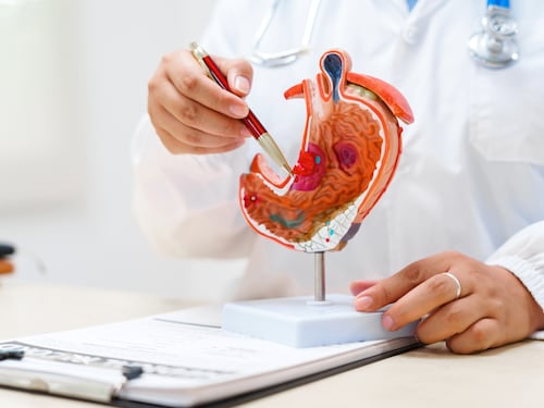 Cancro allo stomaco avanzato, nuova terapia riduce del 42% il rischio di morte