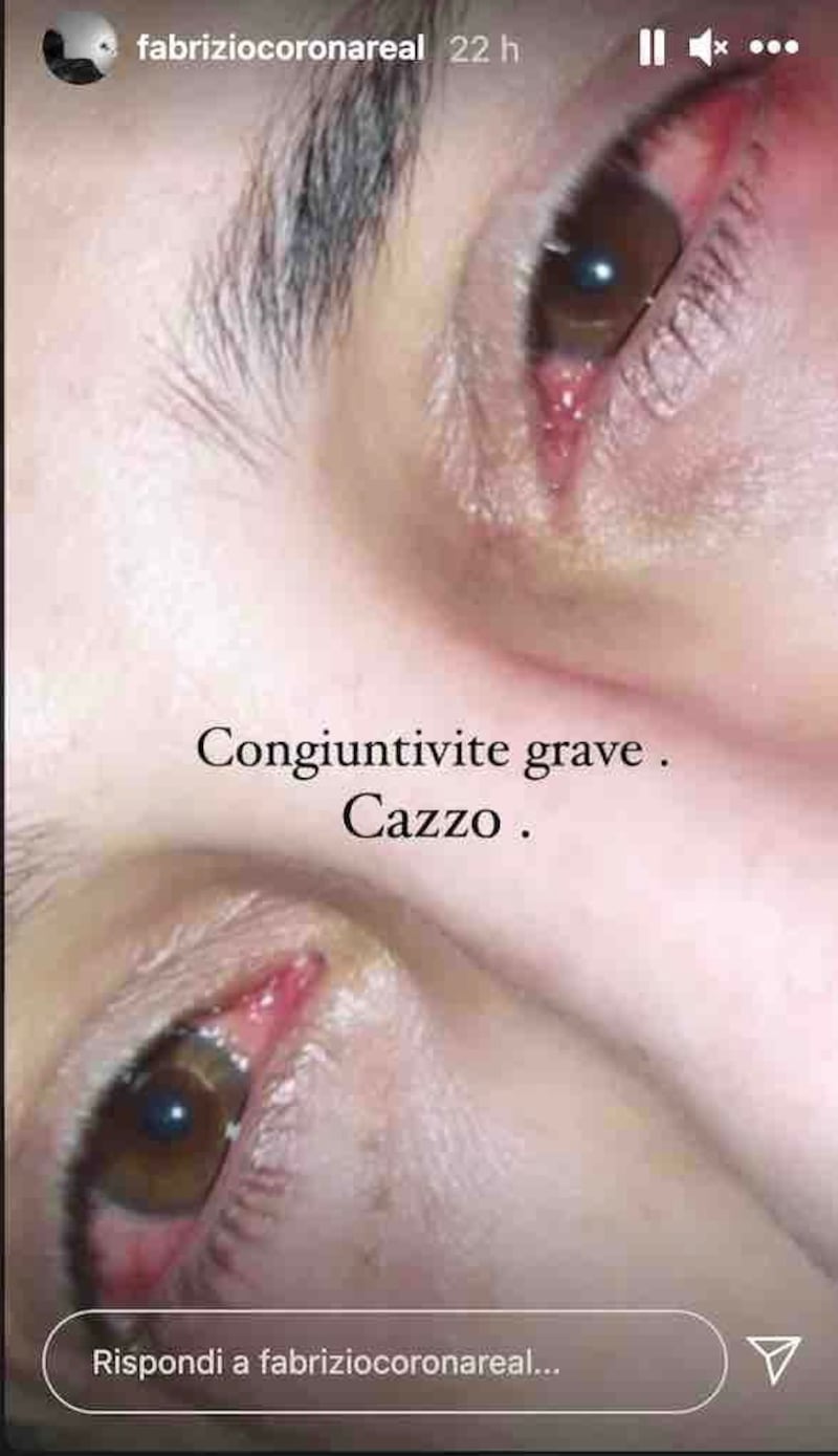 Congiuntivite Fabrizio Corona