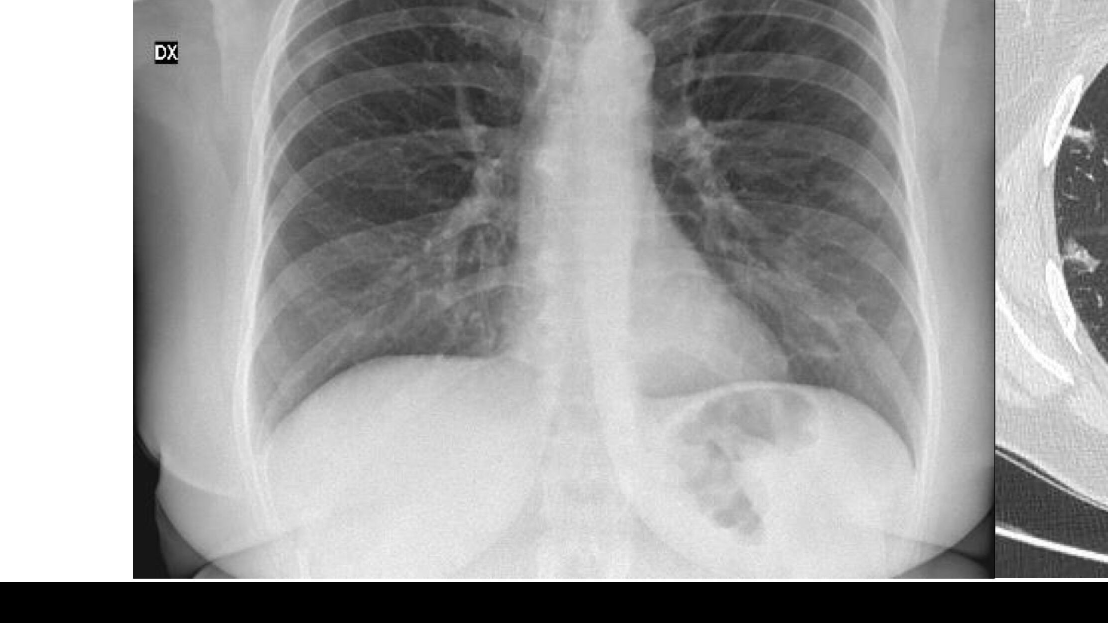 Ecco la radiografia al torace che svela la bomba Covid negli asintomatici