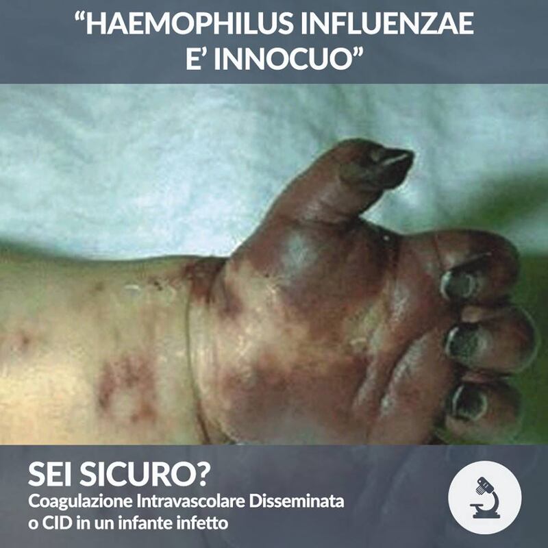 Vaccini, le foto choc: cosa succede a chi non si vaccina 7