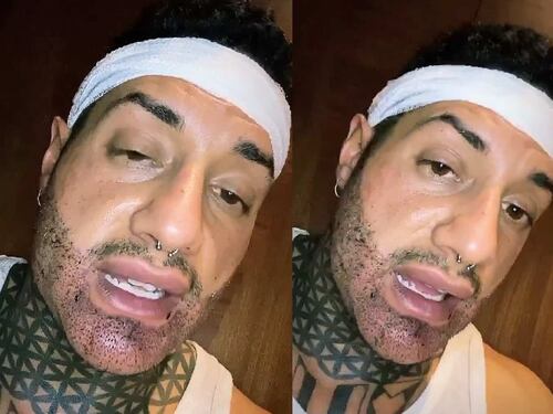 Chiofalo fa il trapianto di barba: ma il post-operazione diventa uno show