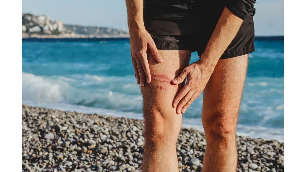 Meduse: cosa fare in caso di puntura?