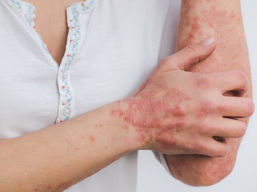 Psoriasi e make up: i consigli della dermatologa