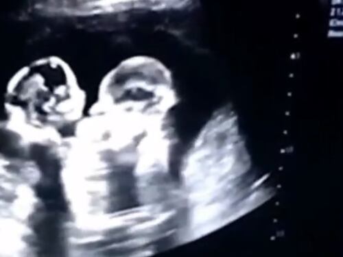 Le gemelline 'combattono' nel grembo materno e il video diventa virale