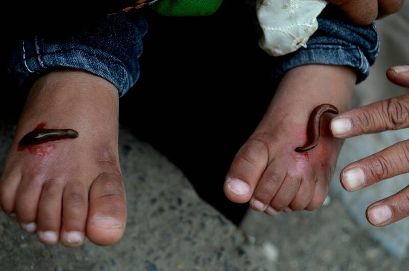 La terapia delle sanguisughe nel Kashmir indiano 9