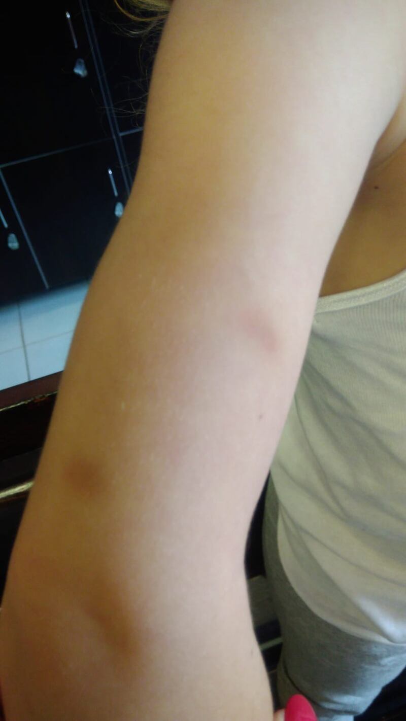 Quei lividi sospetti sul corpo dei bimbi dell'asilo Isola dei Tesori 2