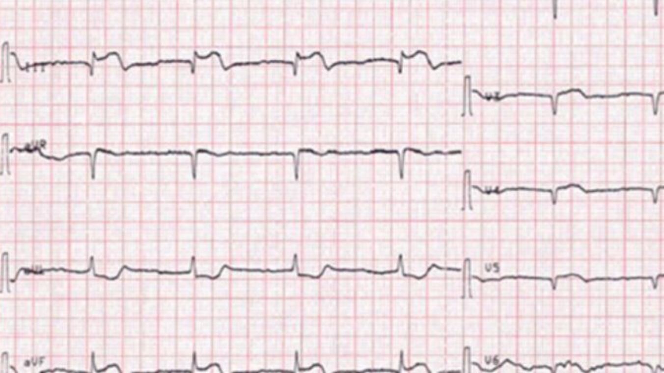 Paura per la sindrome Takotsubo: che cosa accade con il Covid