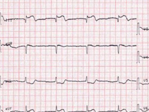 Paura per la sindrome Takotsubo: che cosa accade con il Covid