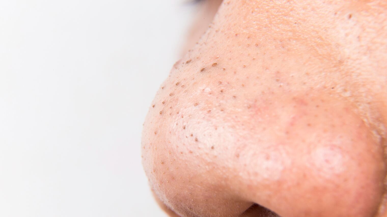 Punti neri sulla pelle: ecco cosa significano