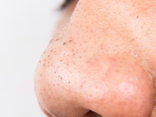 Punti neri sulla pelle: ecco cosa significano