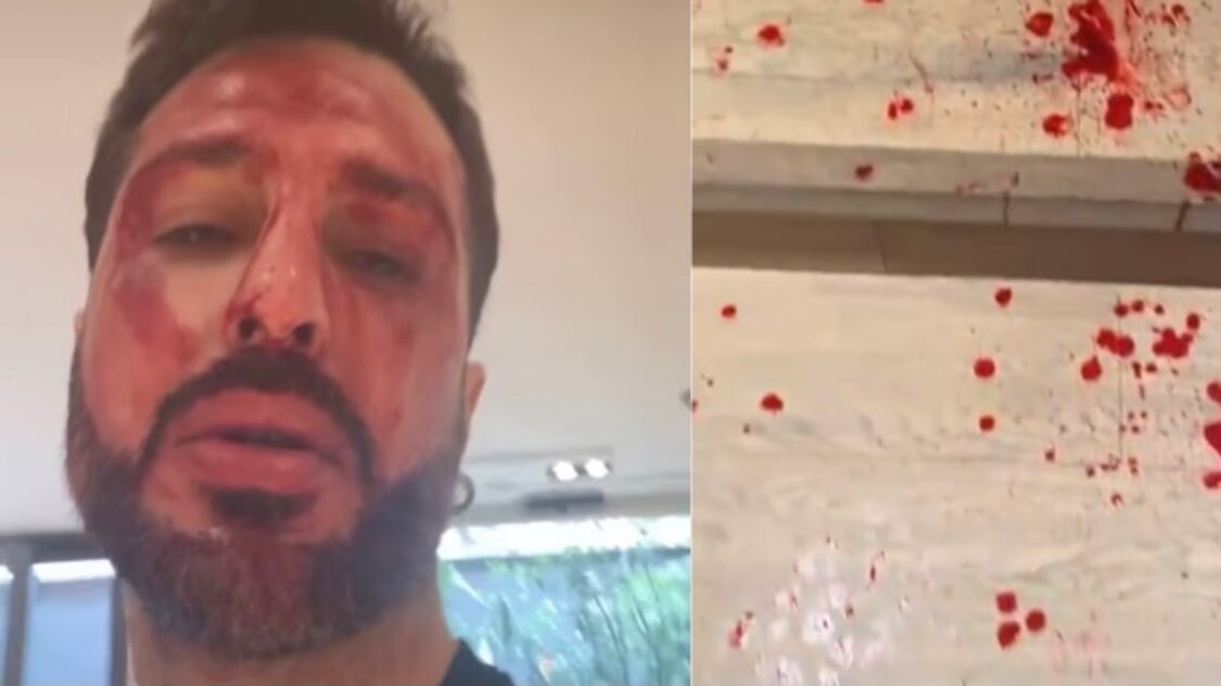 Corona deve tornare in carcere. Per protesta si taglia le vene: "Guardate gli atti o mi tolgo la vita"
