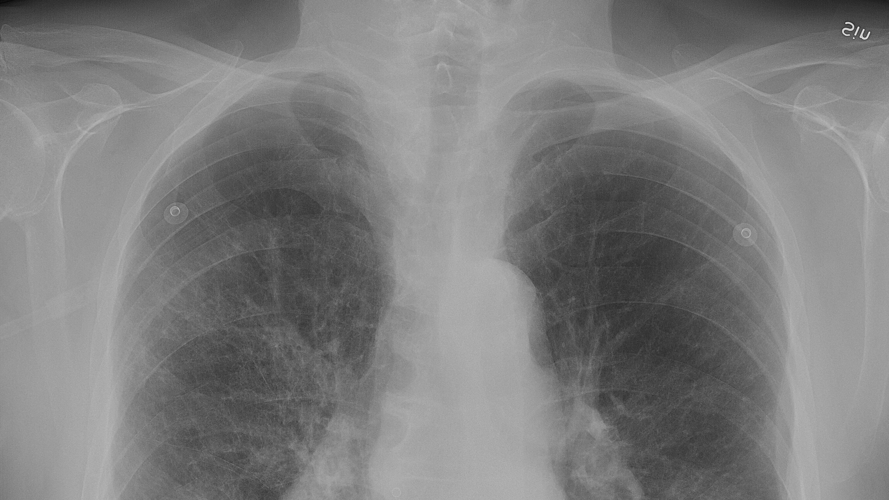Broncopneumopatia cronica ostruttiva e Coronavirus, quali i rischi?