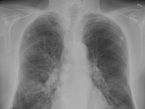 Broncopneumopatia cronica ostruttiva e Coronavirus, quali i rischi?