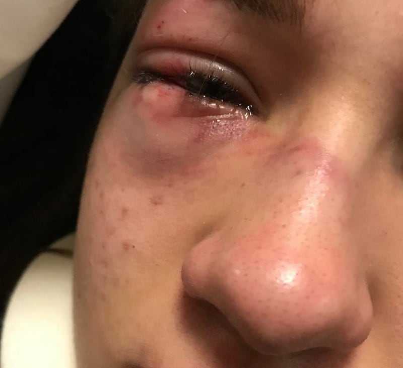 Pestata da bulle in aula al liceo: il padre «posta»  la foto sui social