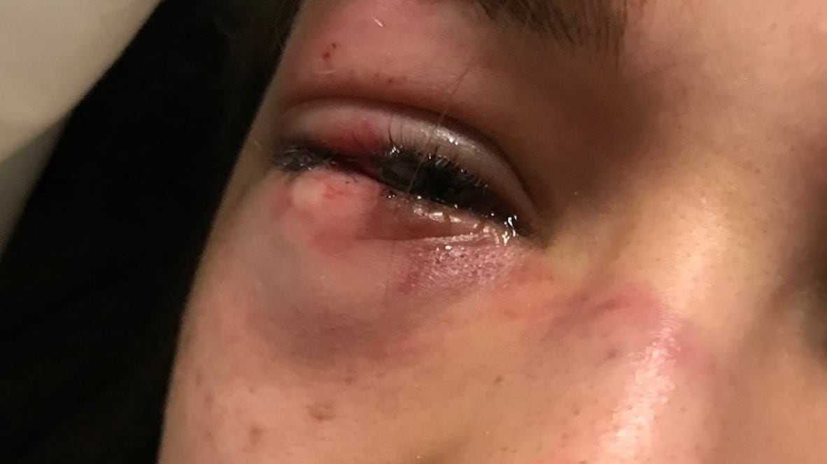 Pestata da bulle in aula al liceo: il padre «posta» la foto sui social