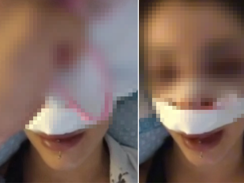 “Io, picchiata dalla baby gang che voleva derubarmi: calci e pugni sul volto”