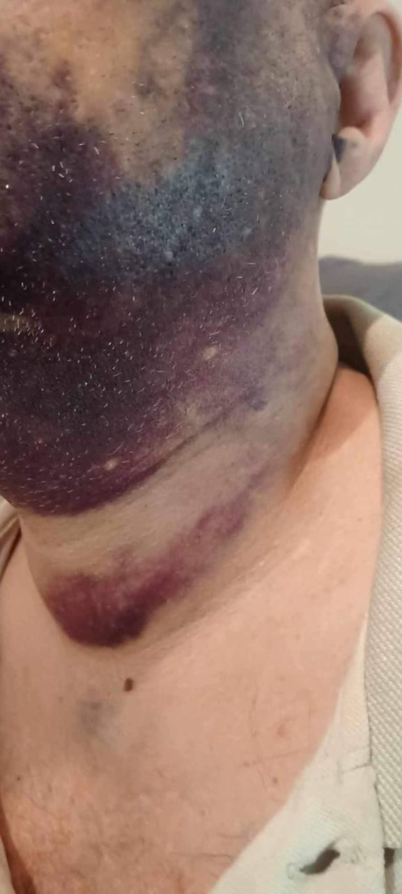 Ilaria Salis, le ferite di László Dudog dopo il pestaggio 2