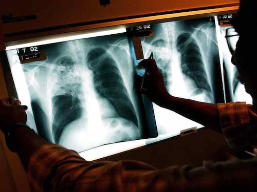 Influenza, casi di polmonite atipica aumentati di 10 volte: quali sono i sintomi a cui fare attenzione