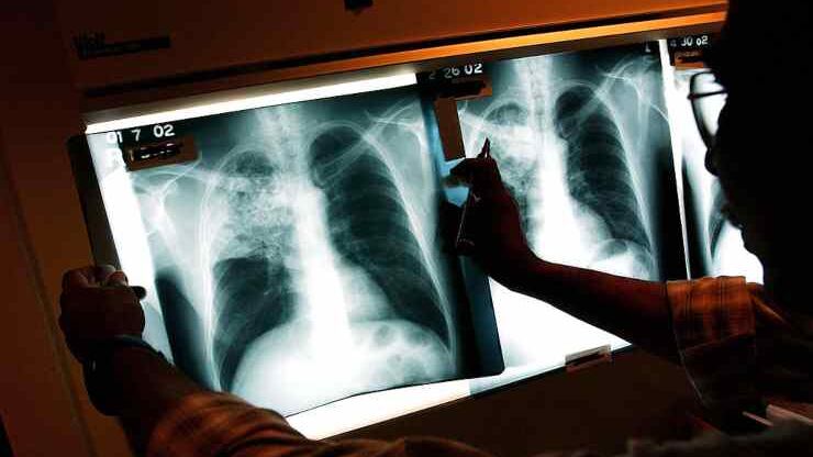 Influenza, casi di polmonite atipica aumentati di 10 volte: quali sono i sintomi a cui fare attenzione