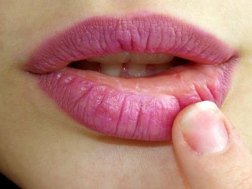 Herpes labiale, come prevenirlo e curarlo